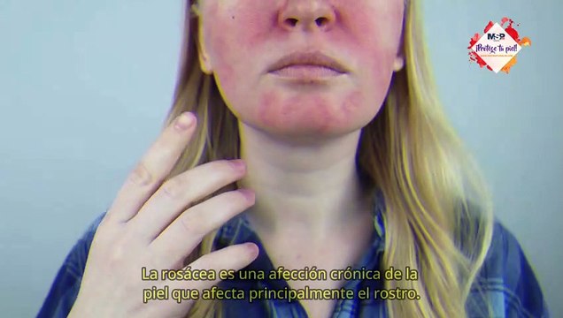 ¿Cómo funciona la rosácea? Así funciona la piel - #ExclusivoMSP