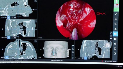 TURC POUR RÉSOUDRE LE CODE GÉNÉTIQUE DE L'ANÉVRYSME