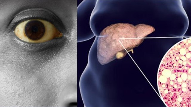 Kala Piliya Kya Hota Hai | Kala Piliya Kitna Khatarnak Hota Hai | काला पीलिया के लक्षण क्या होता है