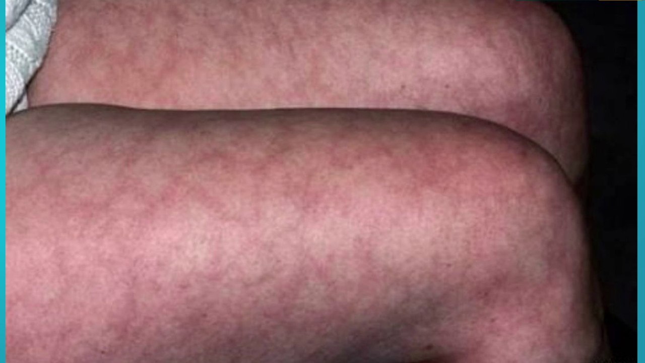 bd-vasculitis-cutanea-causas-sintomas-y-tratamientos-280823