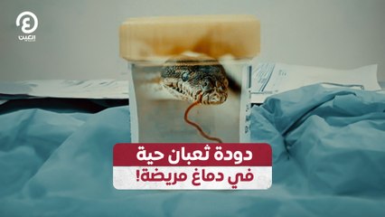 دودة ثعبان حية في دماغ مريضة!