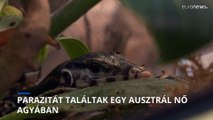 Élő fonálférget húztak ki egy nő agyából a canberrai kórházban