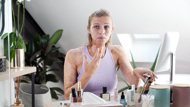 « J’ai appris à aimer mon corps », Julie, brûlée au 3ème degré se confie