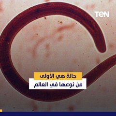 لأول مرة في العالم.. اكتشاف دودة حية طولها 6 سم  بدماغ امرأة أسترالية