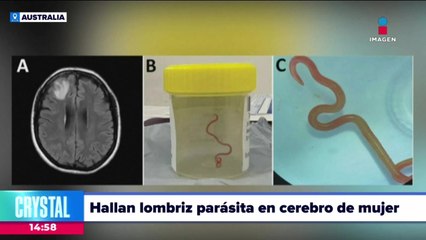 Hallan lombriz parásita en cerebro de una mujer en Australia