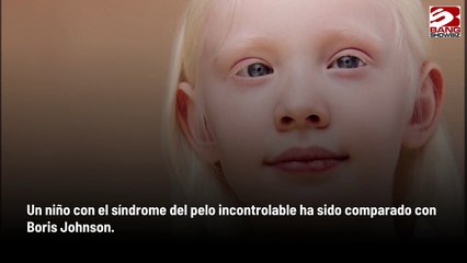 Niño con síndrome del cabello incontrolable es comparado con Boris Johnson por sus mechones rubios