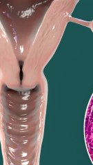 CAM - Comment prévenir le cancer de l'ovaire ?