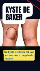 ✅Kyste de Baker : aperçu