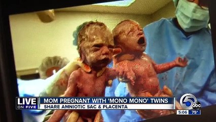 Des jumelles se tiennent la main à la naissance