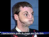 Greffe spectaculaire du visage aux Etats-Unis, la plus étendue à ce jour