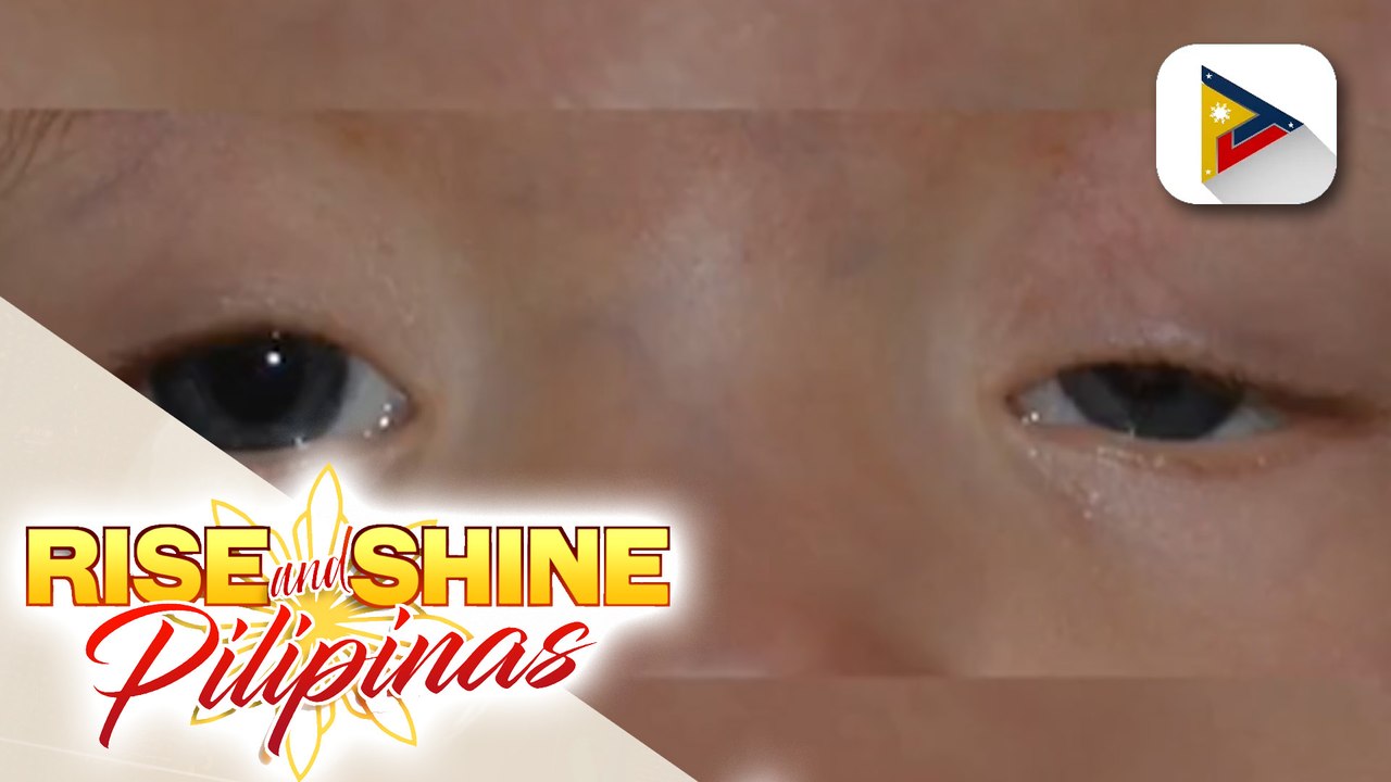 SAY ni DOK | Ptosis o drooping eyelid