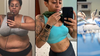 VSG Surgery क्या है | Photographer Ashleigh Bing 45Kg Weight Loss Journey Reveal | Boldsky