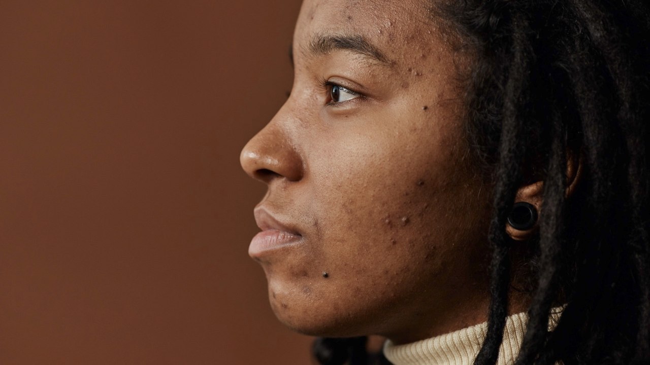 Viral TikTok Warns Against Nose Pimple Popping Due to “Triangle of Death” Risk