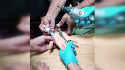 Adıyaman'da İtfaiye Ekipleri Vatandaşın Sıkışan Yüzüğünü Kurtardı