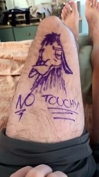 Paciente evita confusiones en cirugía pintando un mensaje en su pierna sana