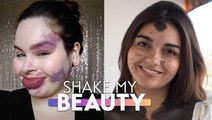 We're Proud Of Our Birthmarks | SHAKE MY BEAUTY