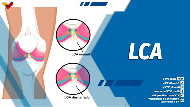 Actitud Saludable | ¿Qué es la lesión del ligamento cruzado anterior?