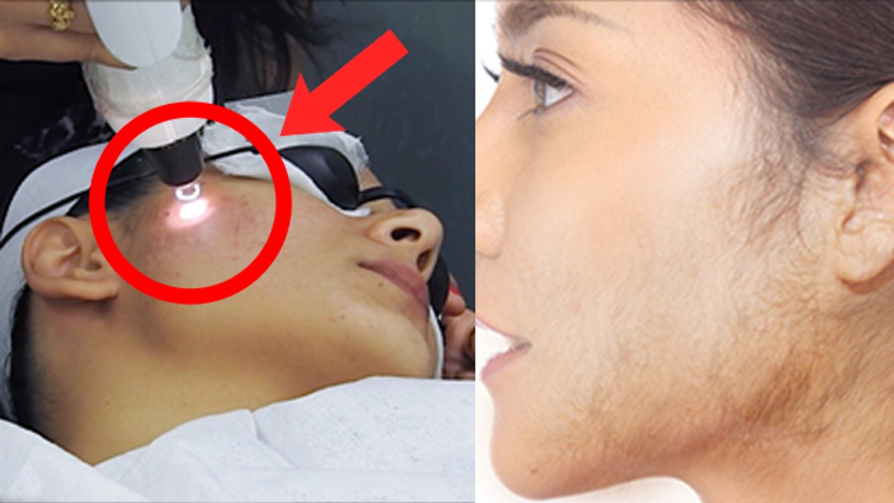 Laser Se Permanent Hair Remove Hota Hai Kya | H...
