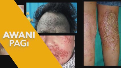 AWANI Pagi: Cabaran pesakit hidap Dermatitis Atopik