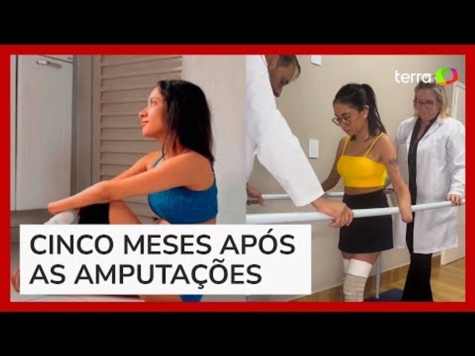 Jovem volta a andar com ajuda de prótese após ter mãos e pés amputados por infecção