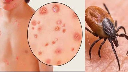 स्क्रब टाइफस कैसे होता है | Scrub Typhus Treatment | Boldsky