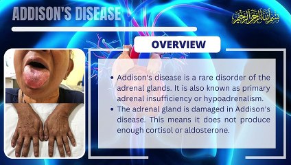 Addison's disease