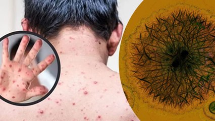 Chickenpox New Variant Clade 9 से India में कितना खतरा, क्या है Clade 9 Symptoms और Precautions