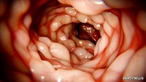 Malattia di Crohn, arriva nuova soluzione terapeutica 