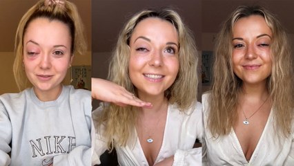 Woman Loses Vision After Mystery Illness