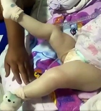 Criança movimenta as pernas pela primeira vez após receber remédio mais caro do mundo