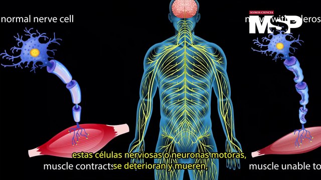 ¿Cómo funciona la esclerosis lateral amiotrófica?