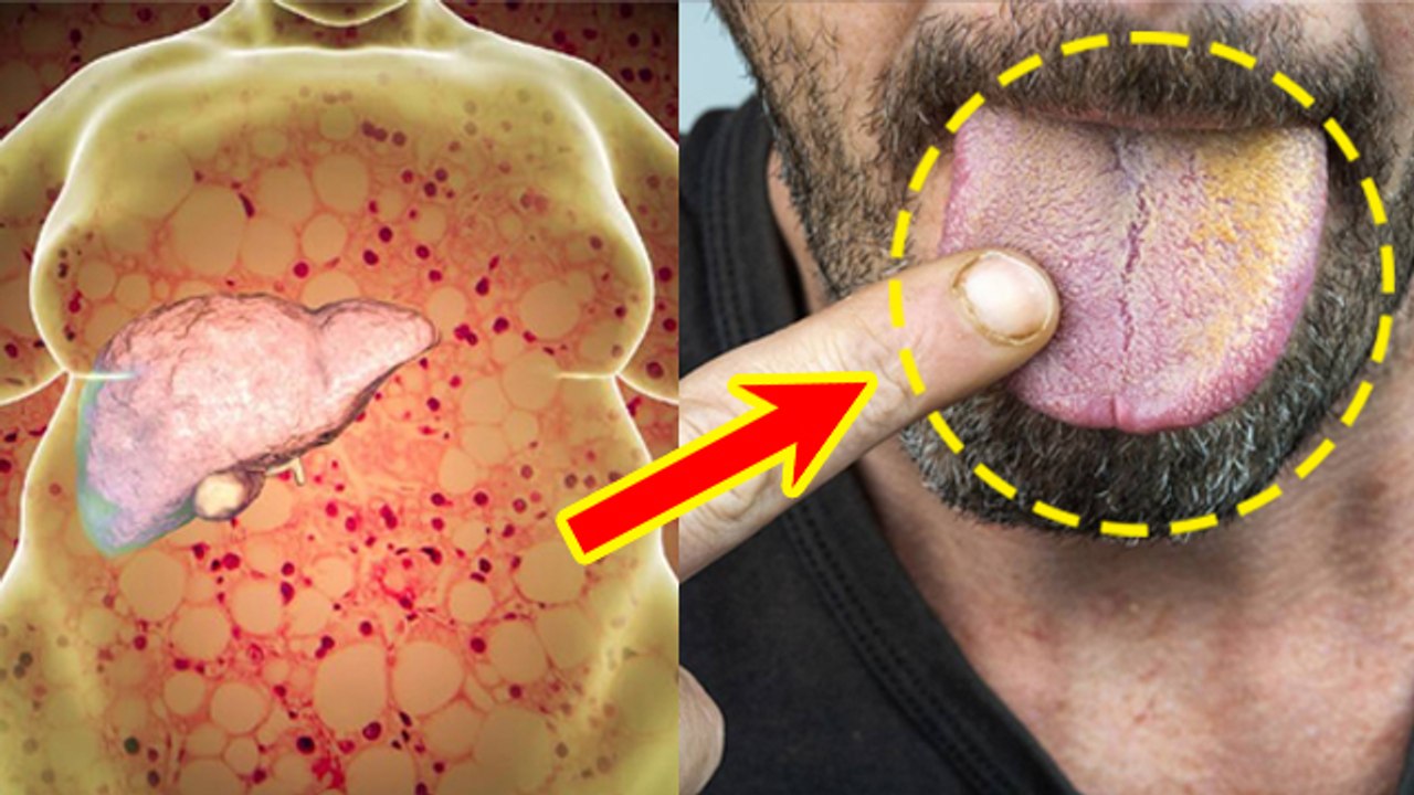 Yellow Tongue Symptoms है Fatty Liver Reason, Causes और Treatment जानना जरूरी | Boldsky