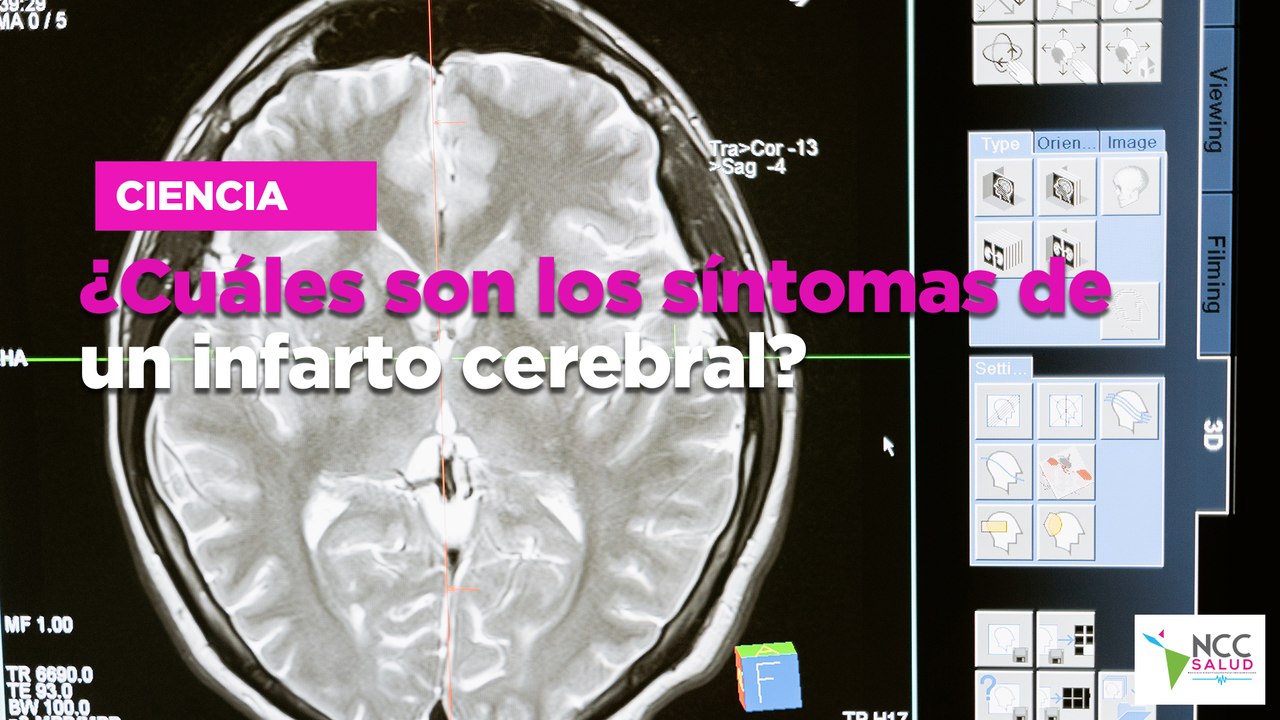 ¿Cuáles son los síntomas de un infarto cerebral?