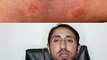 ringworm   tinea corporis   fungal skin infection    tinea infection   fungus   fungal infection