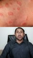 ringworm   tinea corporis   fungal skin infection    tinea infection   fungus   fungal infection