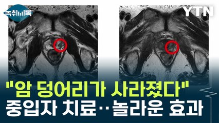 "암 덩이가 사라졌다"...중입자 치료 받은 환자 상태 변화 [Y녹취록] / YTN