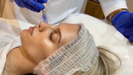 Recuperamos la buena cara tras el verano probando Dermapén Médico MicroEtéreal Beauty Clinic