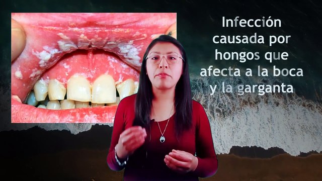 ▷ CANDIDIASIS ORAL: SÍNTOMAS y las CAUSAS DETRÁS de su APARICIÓN