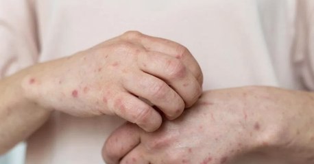 Bình Dương ghi nhận ca bệnh đậu mùa khỉ