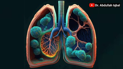 Got Pus-Filled Boils_ Discover the 5 Types of Abscess _ Simple Pus Ka Ilaj & Peep Wale Dano Ka Ilaj