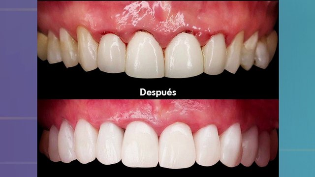 bd-causas-y-posibles-tratamientos-de-la-retraccion-de-encias-280923