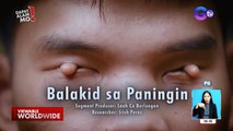 Tumubong kuntil sa mata ng isang lalaki, balakid na raw sa paningin! | Dapat Alam Mo!