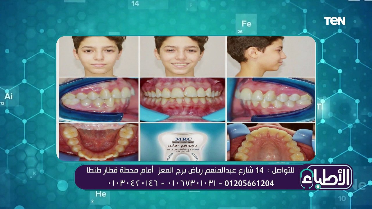 تعرف على أنواع حالات التقويم خلال مرحلة الأسنان المختلطةتقويم خلال مرحلة الأسنان المختلطة