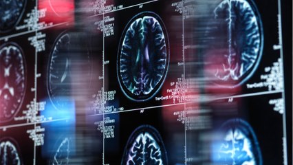 Ärzte finden 3 cm lange Nadel im Gehirn einer Frau, die 80 Jahre lang darin steckte