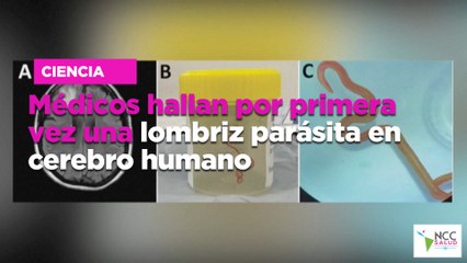 Médicos hallan por primera vez una lombriz parásita en cerebro humano