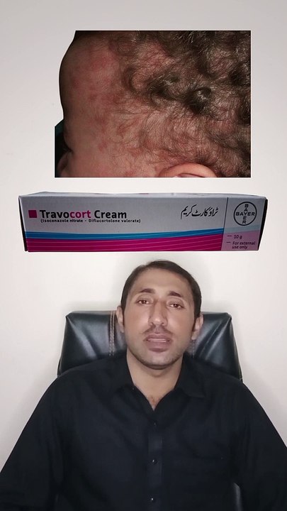 anti fungal cream _ how to treat tinea  _ tinea capitis _ fungal infection on scalp