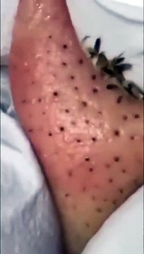 ASMR relaxing Black Heads remove Most satisfying #blackheads #asmr #satisfying