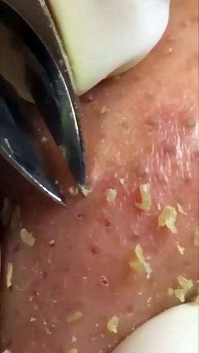 Blackheads and whiteheads remove Most satisfying ASMR relaxing #blackheads #asmr #satisfying