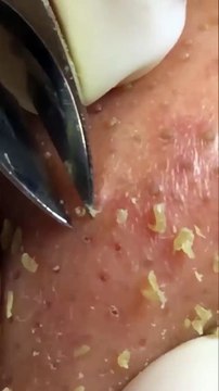 Blackheads and whiteheads remove Most satisfying ASMR relaxing #blackheads #asmr #satisfying