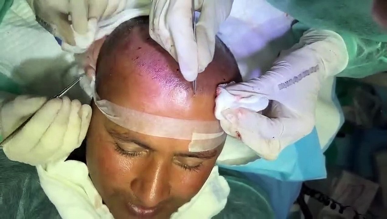 Must Watch Before Hair Transplant - Hair Transplant Complete Process and Final Results - Mubashir